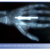 Aneurysmal Bone Cyst In Metacarpal of a Child Aneurysmal Bone Cyst In Metacarpal of a Child