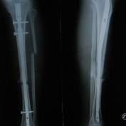 Fat Embolism Syndrome in Fracture Tibia Treated By Unreamed Interlocking Nail