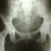 Case 9- Jan -Mar 2012. Journal of Orthopaedic Case Reports