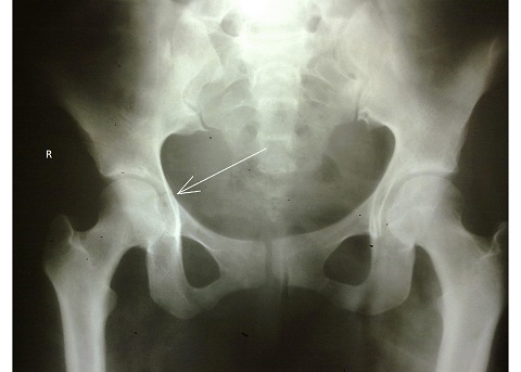 Case 9- Jan -Mar 2012. Journal of Orthopaedic Case Reports