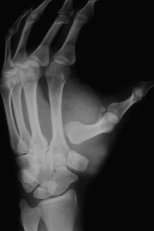 Case 4 – Jan -Mar 2012. Journal of Orthopaedic Case Reports