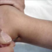 Percutaneous Needle Tenotomy for Tendo-achillis Release in Clubfoot – Technical Note Case 10 – Video Technique. Jan -Mar 2012. Journal of Orthopaedic Case Reports