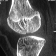 Osteochondritis Dessicans- Primary Fixation using Bioabsorbable Implants Osteochondritis Dessicans- Primary Fixation using Bioabsorbable Implants