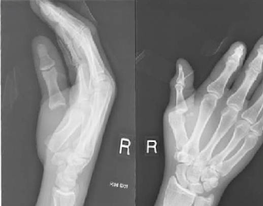 dislocation of the thumb Dislocation of the thumb