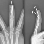 Closed Extension-Block Pinning for Management of Mallet Fracture Closed Extension-Block Pinning for Management of Mallet Fracture