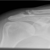 Good Clinical Outcome following Non-operative Treatment of Concomitant Fractures of Coracoid Process and Distal End of Clavicle: A Case Report Good Clinical Outcome following Non-operative Treatment of Concomitant Fractures of Coracoid Process and Distal End of Clavicle: A Case Report