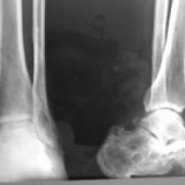 Retrospective Analysis of Varied Clinical Presentations and Delayed Diagnosis in Tuberculosis affection of Extremities Retrospective Analysis of Varied Clinical Presentations and Delayed Diagnosis in Tuberculosis affection of Extremities