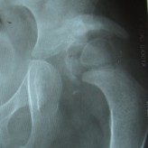 Pseudo-Acetabulum due to Heterotopic Ossification in a Child with Post Traumatic Neglected Posterior Hip Dislocation-Abstract Pseudo-Acetabulum due to Heterotopic Ossification in a Child with Post Traumatic Neglected Posterior Hip Dislocation-Abstract