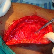 Idiopathic Bilateral Gluteus Maximus Contracture in Adolescent Female: A Case Report