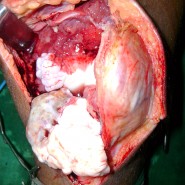 A Case Report of Synovial Chondromatosis of the Knee Joint arising from the Marginal Synovium A Case Report of Synovial Chondromatosis of the Knee Joint arising from the Marginal Synovium