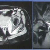 Pyomyositis of Obturator Muscles: Unusual Late Presentation Pyomyositis of Obturator Muscles: Unusual Late Presentation