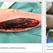 A Traumatic Bilateral Anterolateral Compartment Syndrome and Subsequent small Bowel Obstruction in a Patient with Schizophrenia A Traumatic Bilateral Anterolateral Compartment Syndrome and Subsequent small Bowel Obstruction in a Patient with Schizophrenia