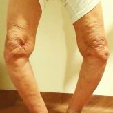 Single-stage Management of Advanced Bilateral Knee Osteoarthritis with Stress Fracture of Medial Malleolus Single-stage Management of Advanced Bilateral Knee Osteoarthritis with Stress Fracture of Medial Malleolus