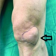 A Giant Ganglion Cyst Arising from Lateral Hoffa’s Fat Pad of the Knee A Giant Ganglion Cyst Arising from Lateral Hoffa’s Fat Pad of the Knee