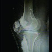 Managing Recurrence in Intraarticular Melorheostosis Involving the Knee Joint: A Case Report Managing Recurrence in Intraarticular Melorheostosis Involving the Knee Joint: A Case Report