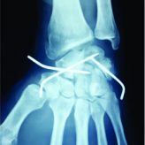 Floating Forearm with Terrible Triad Injury of the Elbow: A Case Report Floating Forearm with Terrible Triad Injury of the Elbow: A Case Report