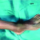Chondroblastoma of the Medial Malleolus: A Case Report of A Rare Tumor at an Extremely Uncommon Site Chondroblastoma of the Medial Malleolus: A Case Report of A Rare Tumor at an Extremely Uncommon Site