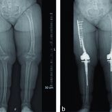 Two-staged Bilateral, Femoral Alignment Osteotomy with Concomitant Total Knee Arthroplasty in an Achondroplasia Patient – A Case Report Two-staged Bilateral, Femoral Alignment Osteotomy with Concomitant Total Knee Arthroplasty in an Achondroplasia Patient – A Case Report