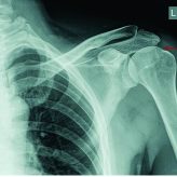 Intra-articular Loose Body with Concomitant Bankart Lesion after a Traumatic Shoulder Dislocation: A Case Report Jason B T Lim1, Andrew H C Tan1 Intra-articular Loose Body with Concomitant Bankart Lesion after a Traumatic Shoulder Dislocation: A Case Report Jason B T Lim1, Andrew H C Tan1