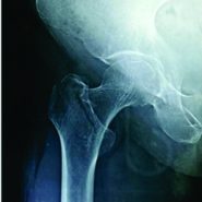 Minimal Invasive Dynamic Hip Screw Fixation Technique in Patient with Cardiac Complications: A Case Scenario Minimal Invasive Dynamic Hip Screw Fixation Technique in Patient with Cardiac Complications: A Case Scenario