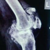 A Patient with Osteoarthritis Knee and Prior Patella Fracture: Single Stage Fixation and Total Knee Arthroplasty: A Case Report A Patient with Osteoarthritis Knee and Prior Patella Fracture: Single Stage Fixation and Total Knee Arthroplasty: A Case Report