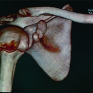 An Isolated Displaced Fracture of the Coracoid Process Treated with Open reduction and internal fixation- A Case Report and Review of Literature An Isolated Displaced Fracture of the Coracoid Process Treated with Open reduction and internal fixation- A Case Report and Review of Literature