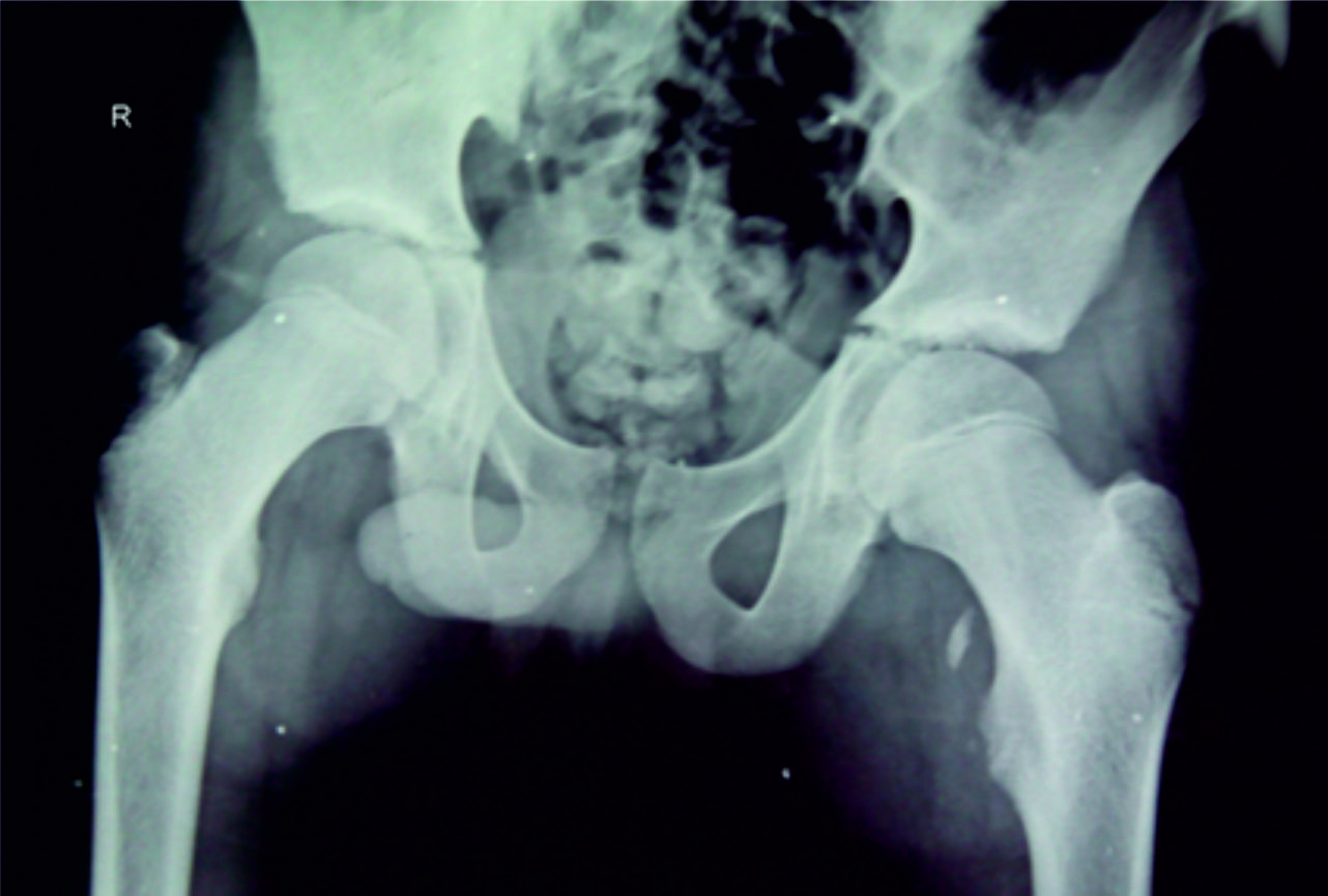 Isolated Avulsion Fractures of Lesser Trochanter in ...