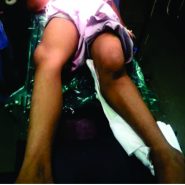 Proximal Tibial Epiphysis Injury (Flexion Type, Salter–Harris Type 1) Proximal Tibial Epiphysis Injury (Flexion Type, Salter–Harris Type 1)