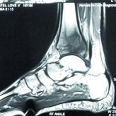 Bifocal Cryptococcal Osteomyelitis in an Immunocompetent Male Bifocal Cryptococcal Osteomyelitis in an Immunocompetent Male
