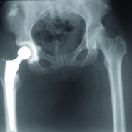 Total Hip Arthroplasty Indicated for a Tuberculous Coxitis Complicating a Controlled Acquired Imunodefficiency Syndrom Condition: A Preliminary Report Concerning a Case Total Hip Arthroplasty Indicated for a Tuberculous Coxitis Complicating a Controlled Acquired Imunodefficiency Syndrom Condition: A Preliminary Report Concerning a Case