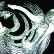 Unusual Medial-End Clavicle Fracture Combined with Double Disruption of the Superior Shoulder Suspensory Complex (SSSC): A Case Report in Triathlon Athlete Unusual Medial-End Clavicle Fracture Combined with Double Disruption of the Superior Shoulder Suspensory Complex (SSSC): A Case Report in Triathlon Athlete