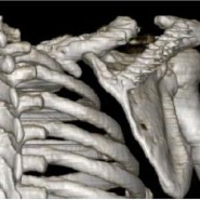 Ipsilateral Closed Clavicle and Scapular Spine Fracture with Acromioclavicular Joint Disruption Ipsilateral Closed Clavicle and Scapular Spine Fracture with Acromioclavicular Joint Disruption