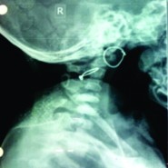 Spinal Cord Injury without Radiological Abnormality in an 8 Months Old Female Child: A Case Report Spinal Cord Injury without Radiological Abnormality in an 8 Months Old Female Child: A Case Report