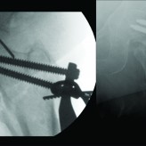 Intra-Pelvic Migration of Sliding Hip Screw During Osteosynthesis of Hip Fracture: A Rare Avoidable Intraoperative Complication Intra-Pelvic Migration of Sliding Hip Screw During Osteosynthesis of Hip Fracture: A Rare Avoidable Intraoperative Complication