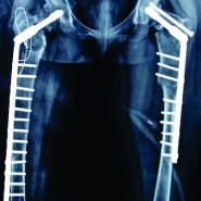 Single Stage Treatment of Non – Union of Transcervical Neck Femur Fracture with Shepherd Crook Deformity of Proximal Femur in A Case of Fibrous Dysplasia using Dynamic Hip Screw Fixation Single Stage Treatment of Non – Union of Transcervical Neck Femur Fracture with Shepherd Crook Deformity of Proximal Femur in A Case of Fibrous Dysplasia using Dynamic Hip Screw Fixation