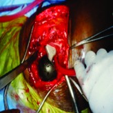 Simultaneous Bilateral Femur Neck Fracture in A Young Adult with Chronic Renal Failure- A Case Report and Review of Literature Simultaneous Bilateral Femur Neck Fracture in A Young Adult with Chronic Renal Failure- A Case Report and Review of Literature