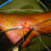 Eckert and Davis Grade 3 Superior Peroneal Retinaculum Injury: Treated by Endoscopic Peroneal Retinaculum Reconstruction and Complicated by Malposition of the Suture Anchors Eckert and Davis Grade 3 Superior Peroneal Retinaculum Injury: Treated by Endoscopic Peroneal Retinaculum Reconstruction and Complicated by Malposition of the Suture Anchors