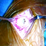 Streptococcus pyogenes Associated Post-traumatic Brodie’s Abscess of Cuboid: A Case Report and Review of Literature Streptococcus pyogenes Associated Post-traumatic Brodie’s Abscess of Cuboid: A Case Report and Review of Literature