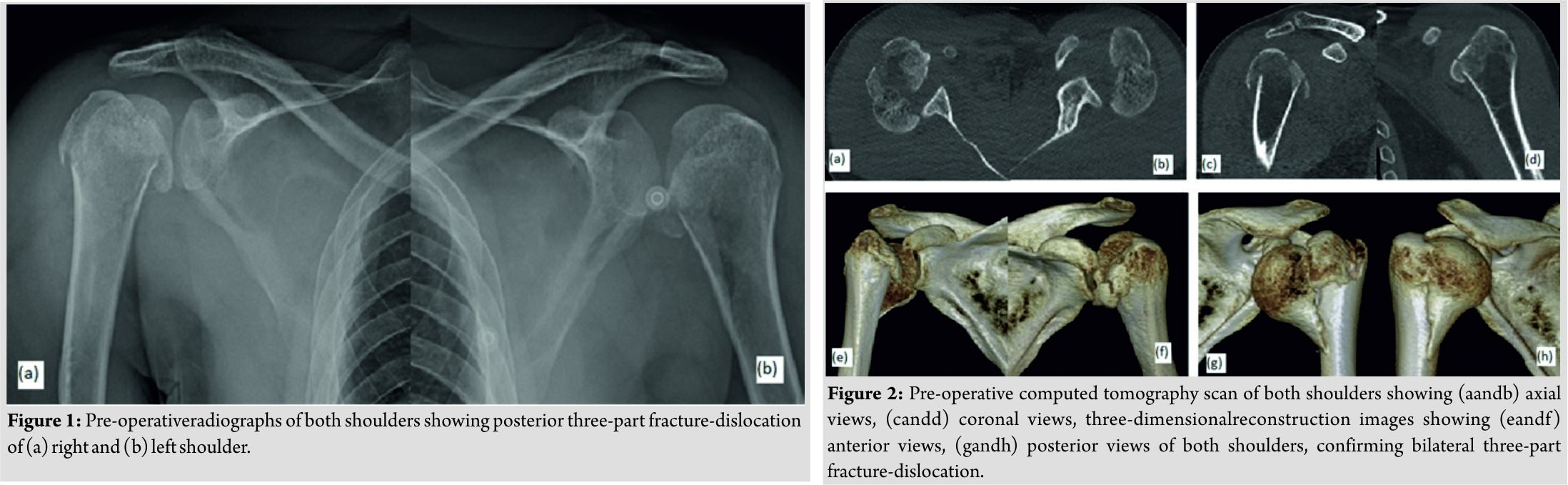 Arthrotomy Shoulder