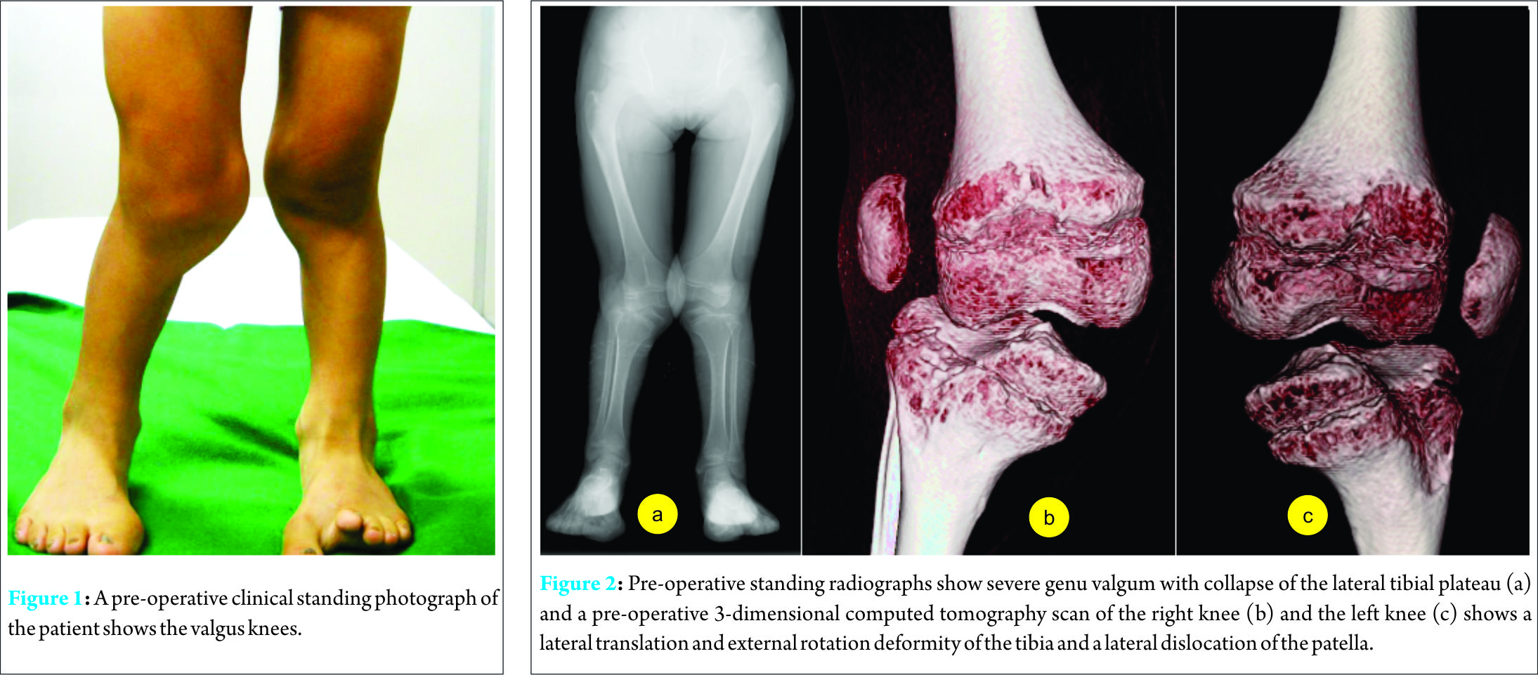 successful two step correction for severe genu valgum in ellis van genu valgum