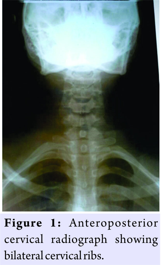 thoracic outlet syndrome from bilateral cervical ribs a clinical