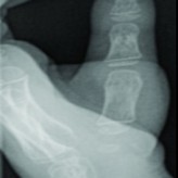Delayed Presentation of Metacarpophalangeal Joint Dislocation of the Thumb in Children Requiring Open Reduction: Two Cases Reported and Review of Literature Delayed Presentation of Metacarpophalangeal Joint Dislocation of the Thumb in Children Requiring Open Reduction: Two Cases Reported and Review of Literature