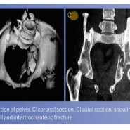 Ipsilateral Traumatic Posterior Hip Dislocation, Posterior Wall and Transverse Acetabular Fracture with Trochanteric Fracture in an adult: Report of First Case Ipsilateral Traumatic Posterior Hip Dislocation, Posterior Wall and Transverse Acetabular Fracture with Trochanteric Fracture in an adult: Report of First Case