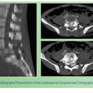 Posterior Reconstruction of Vertebral Body using Expandable Cage for L5 Burst Fracture Dislocation: Case Report