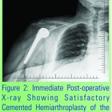 An Unusual Disengagement of the Humeral Head Component after Hemiarthroplasty: A Case Report Presentation An Unusual Disengagement of the Humeral Head Component after Hemiarthroplasty: A Case Report Presentation