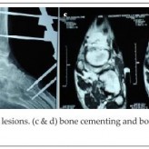 A Rare Cause of Postoperative Bleeding from A Lytic Lesion of Calcaneum A Rare Cause of Postoperative Bleeding from A Lytic Lesion of Calcaneum