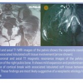 Tophus of the Pubis Bone: A Case Report Tophus of the Pubis Bone: A Case Report