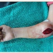 Acute Compressive Ulnar Neuropathy In A Patient Of Dengue Fever: An Unusual Presentation Acute Compressive Ulnar Neuropathy In A Patient Of Dengue Fever: An Unusual Presentation