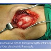 Intramuscular Myxoma – A Rare Tumor Intramuscular Myxoma – A Rare Tumor