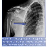Isolated  Tubercular Osteomyelitis of Scapula – A Report of Two Cases and Review of Literature